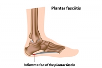 Healing Plantar Fasciitis