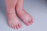 Reasons the Feet Can Become Swollen