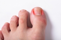 How Ingrown Toenails Can Develop