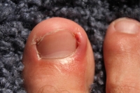 Do You Have an Ingrown Toenail?