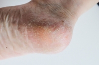 Risk Factors and Causes of Cracked Heels