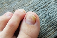 A Closer Look At Onychomycosis Toenail Fungus